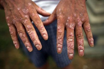 Soldier showing skin lesions caused from exposure of Agent Orange during the Vietnam War.
