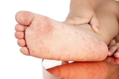 Rash on foot.