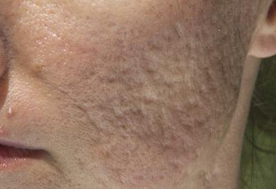 Facial scars can be embarrassing.