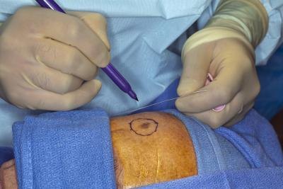 How Does Malignant Melanoma Start?