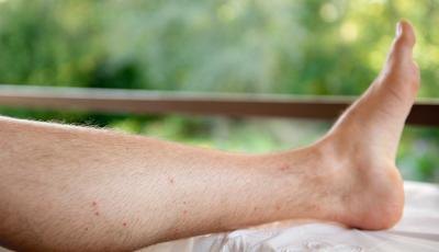 Swelling in the foot may be a sign of DVT.