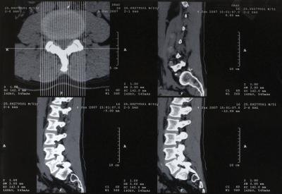Scans of lumbosacral spine.