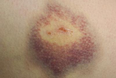 Reapply until the bruise fades.