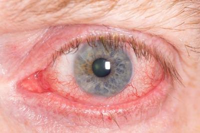 Close up of irritated eye.