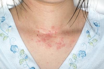 A rash may be a sign of lobster allergy.