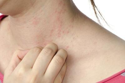 There are many skin conditions that are misdiagnosed as ringworm.