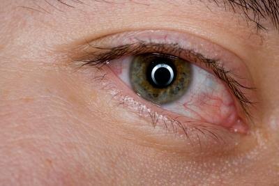 Eye irritation is a symptom of ink poisoning.