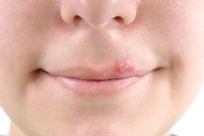 Use an OTC cold sore cream such as Abreva.