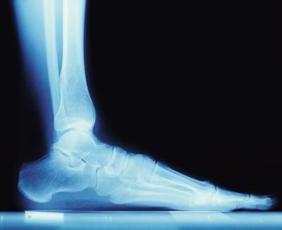 X-ray of foot.