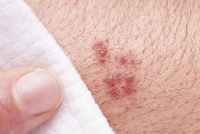 A shingles rash.