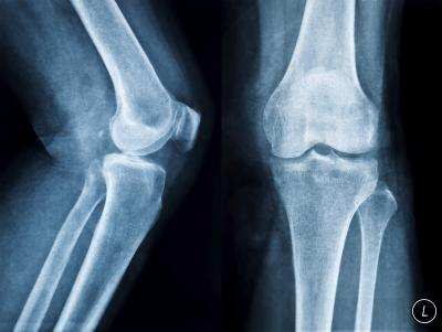 An X-ray of the knees.