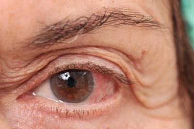 Pink eye.