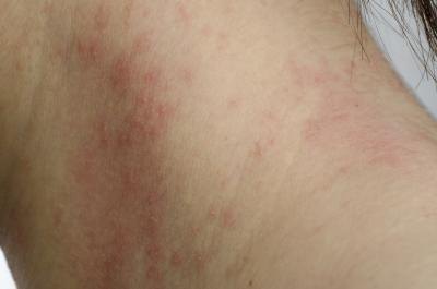 If you develop a skin rash contact your doctor immediately.