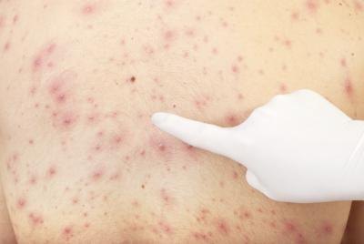chicken pox on adult's back