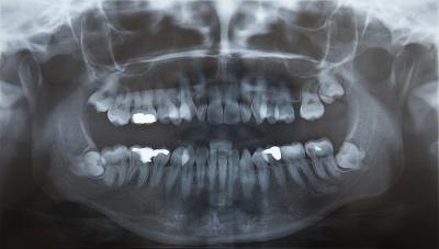 Wisdom tooth extraction recovery depends on your post-operation actions.