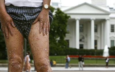 Korean veteran showing skin lesions due to exposure to Agent Orange during the Vietnam War.