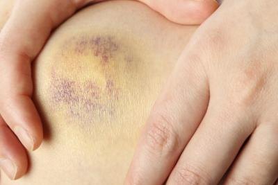 Apply pressure to wound and keep ice pack on for 20 minutes,\.