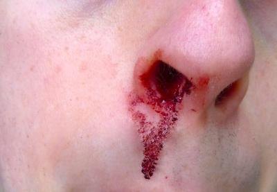 Treating nosebleeds for infants is simple.