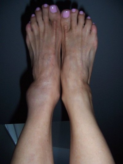 Swelling in the ankle is caused by deep vein thrombosis.