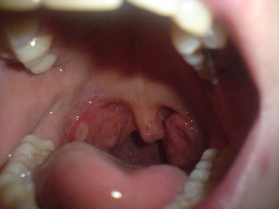 Strep Throat with White Patches