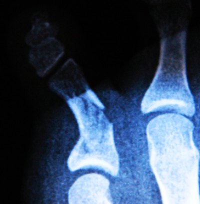 Can joint pain be from shingles?