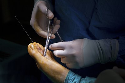 Patients have a success rate for plantar fascia surgery as high as 70 to 90 percent.