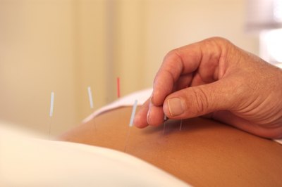 Acupuncture.