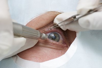 Treatment of an eye by ultrasound.