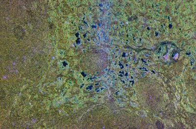 Microscopic view of lymphoma.