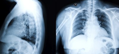 Have a chest x-ray.