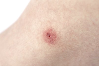 Red, inflamed bug bite.