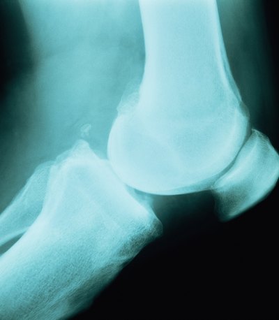 X-ray of knee.