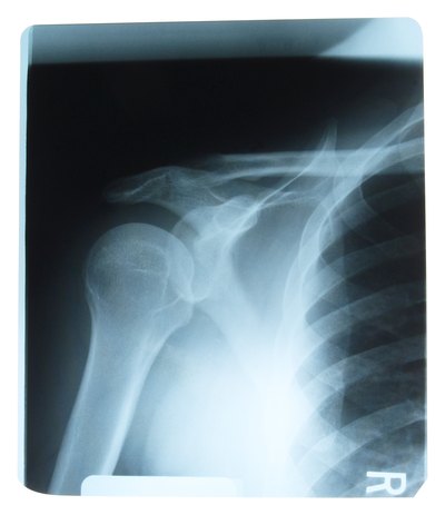 Shoulder x-ray shows bones and cartilage