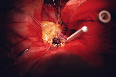 Open Heart Surgery