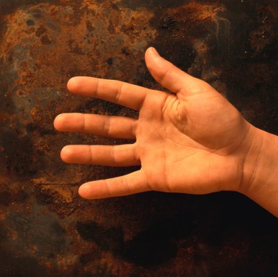 A Dupuytren's contracture is best described as a thickening of the skin in the palm and fingers.