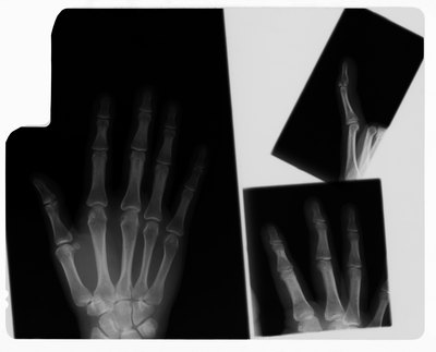 Hand x-rays