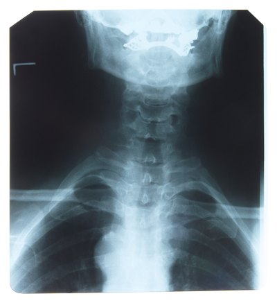 X-ray of Spinal Cord