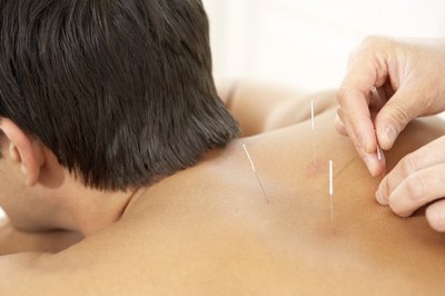 Alternative remedies, such as acupuncture