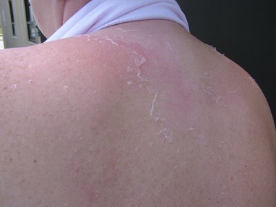 a common type of first degree burn is a sun burn.