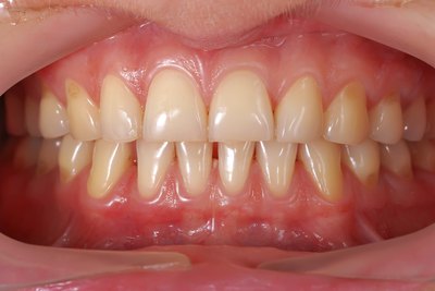 Gums and teeth.