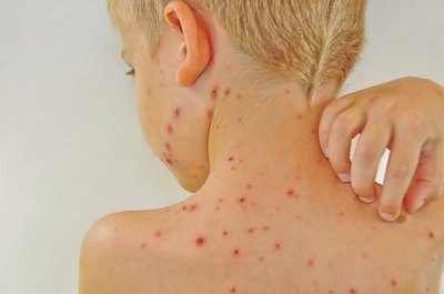If you had chicken pox as a child you may develop shingles as an adult.