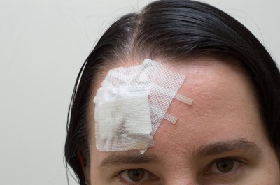 Head injury may cause double vision.