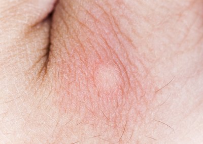 Mosquito bite.
