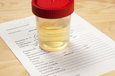 A clean catch specimen is used for bacterial culture and sensitivity.