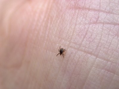 Tick on human skin.