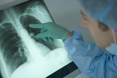 Doctor pointing at lung X-ray