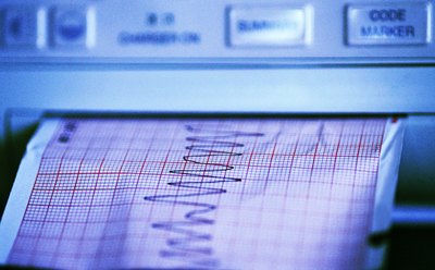 Electro cardiogram printout