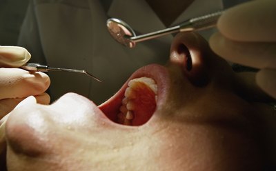 Tooth filling