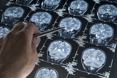 These migraines are possibly caused by an obstructed flow of blood to the brain.
