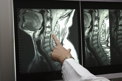 Your doctor may order an MRI to determine if a nerve is being pinched.